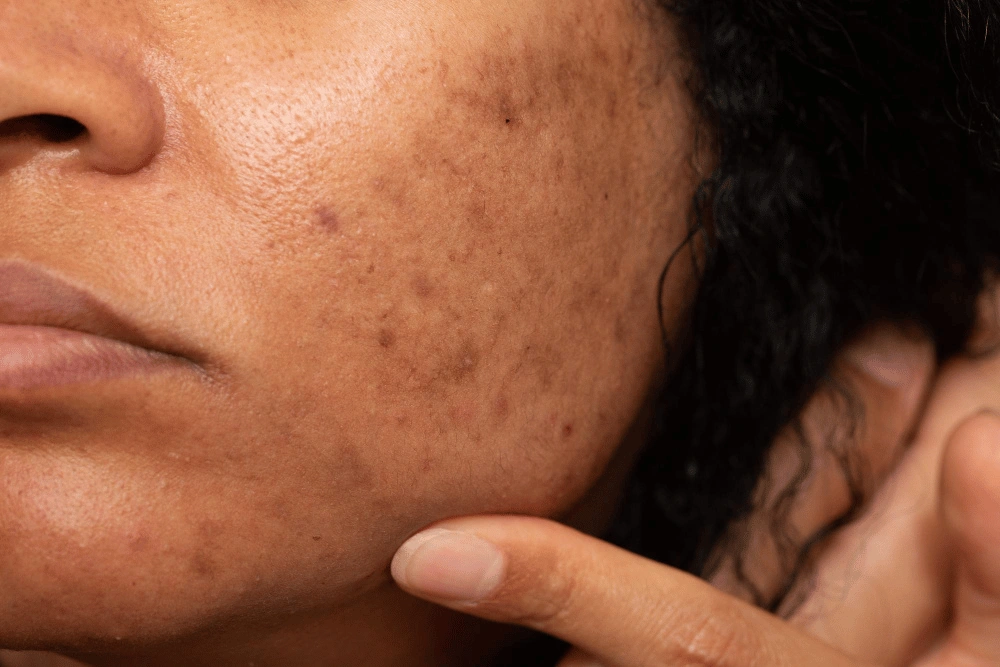 Hyperpigmentation Hyperpigmentation