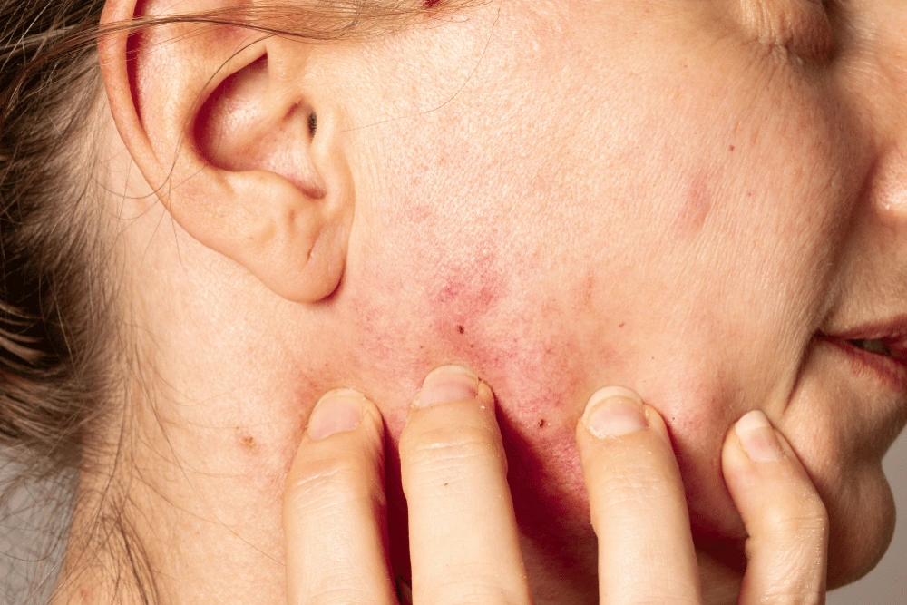 Rosacea and inflammation Rosacea and inflammation